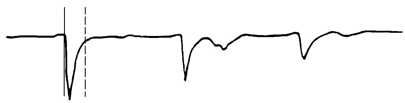 遠端故障線芯與良好線芯不連接的波形 遠端故障線芯與良好線芯不連接的波形